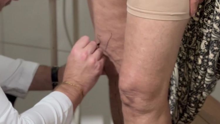 Mutirão de Cirurgia de Varizes inicia 3ª etapa em Imperatriz com 455 vagas